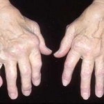 Rheumatoid Arthritis
