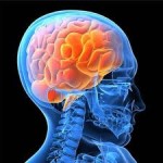 Brain Stroke