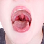 Tonsils